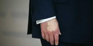 معتقد خرافي.. ترامب يكشف سبب ظهور كدمات على يديه